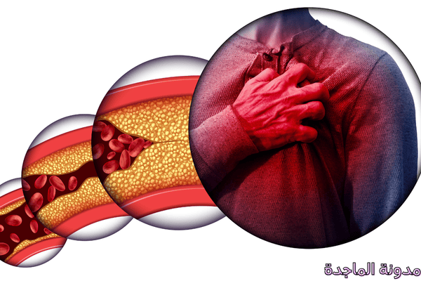 ضغط الدم - الامراض المزمنة