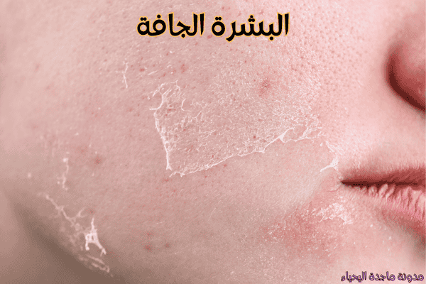 روتين العناية بالبشرة في الشتاء- البشرة الجافة