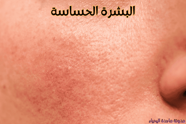 روتين العناية بالبشرة في الشتاء - البشرة الحساسة