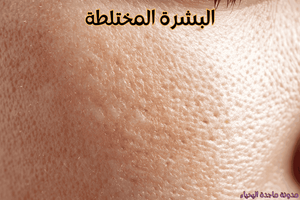 روتين العناية بالبشرة في الشتاء - البشرة المختلطة